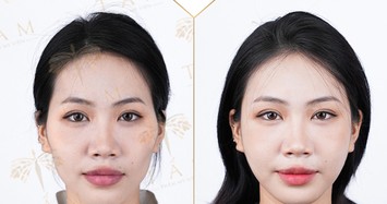 Lý do khiến các chị em lựa chọn tiêm filler tại Thẩm mỹ viện Tấm 