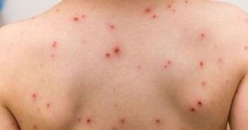 Số ca mắc sởi tăng chóng mặt tại nhiều khu vực trên thế giới, Bộ Y tế khuyến cáo gì?