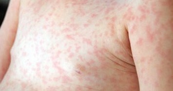 Hà Nội thêm gần 300 ca mắc sốt xuất huyết, 7 ca mắc sởi