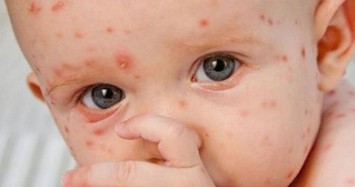 90% người chưa có miễn dịch dễ mắc căn bệnh này