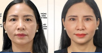 U50 chia sẻ trải nghiệm thực tế sau khi cắt mí tại Dr. Eye