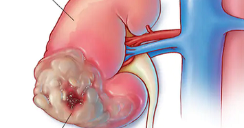 Lưu ý loạt triệu chứng ung thư thận nhiều người bỏ qua
