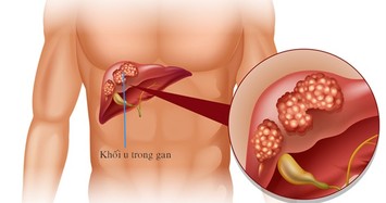 Bệnh gan ông Trần Bắc Hà mắc dễ dẫn đến tử vong như thế nào?