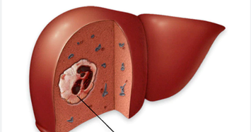 3 dấu hiệu ung thư gan dễ bị bỏ qua