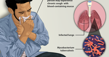 Ai có nguy cơ mắc bệnh lao cao hơn?