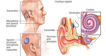 Cấy ốc tai điện tử và loạt biến chứng nguy hiểm