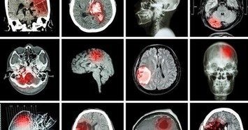 Bị nhồi máu não do nấu nướng bất cẩn