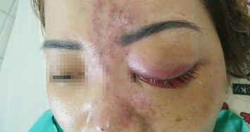 Kinh hoàng những vụ spa không phép tiêm filler gây biến chứng, tàn phế suốt đời