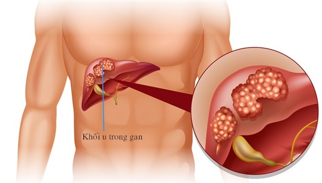 Bệnh gan ông Trần Bắc Hà mắc dễ dẫn đến tử vong như thế nào?