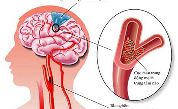 Nắng nóng 41 độ, hãy chú ý đến 7 dấu hiệu sớm của đột quỵ này để giúp bạn thoát chết 