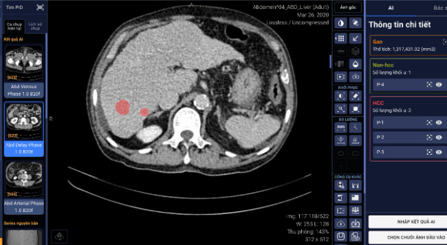 VinBrain cùng Bệnh viện Đại học Y dược phát hiện và chẩn đoán ung thư gan bằng AI