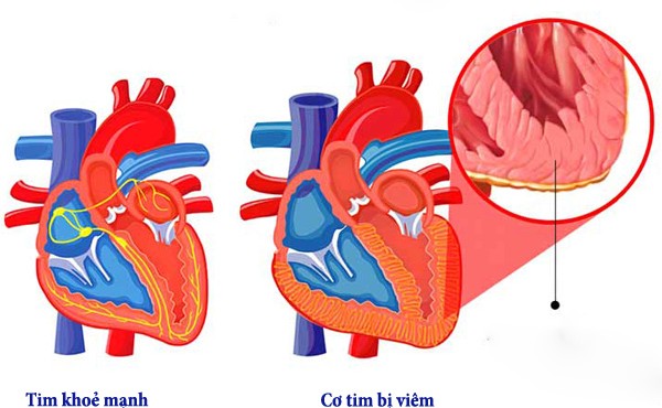 Những điều cần biết về bệnh viêm cơ tim sau 2 ca tử vong ở Hà Nội