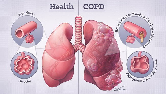 Sự nguy hiểm của bệnh phổi tắc nghẽn mạn tính 