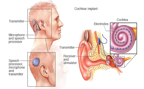 Cấy ốc tai điện tử và loạt biến chứng nguy hiểm