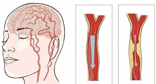 Bác sĩ lưu ý gì khi bệnh nhân U50 nhồi máu não qua đời?