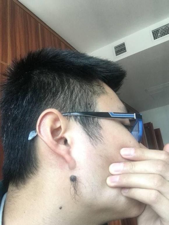 Những nốt ruồi may mắn không nên loại bỏ - Hình 5 Nhung not ruoi may man khong nen loai bo-Hinh-5