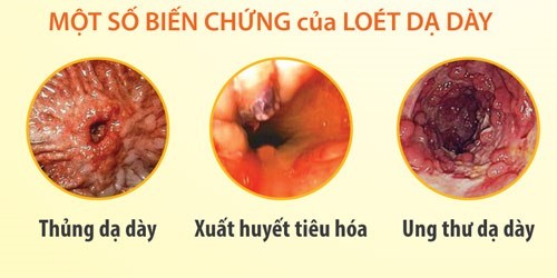 Canh giac voi benh loet da day nhu cua nghe si Mac Can-Hinh-2