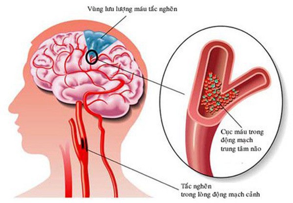 Nang nong 41 do, hay chu y den 7 dau hieu som cua dot quy nay de giup ban thoat chet